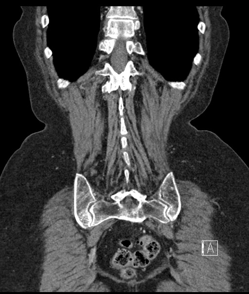 Calcified adrenal glands and Spigelian hernia (Radiopaedia 49741-54988 B 100).jpg