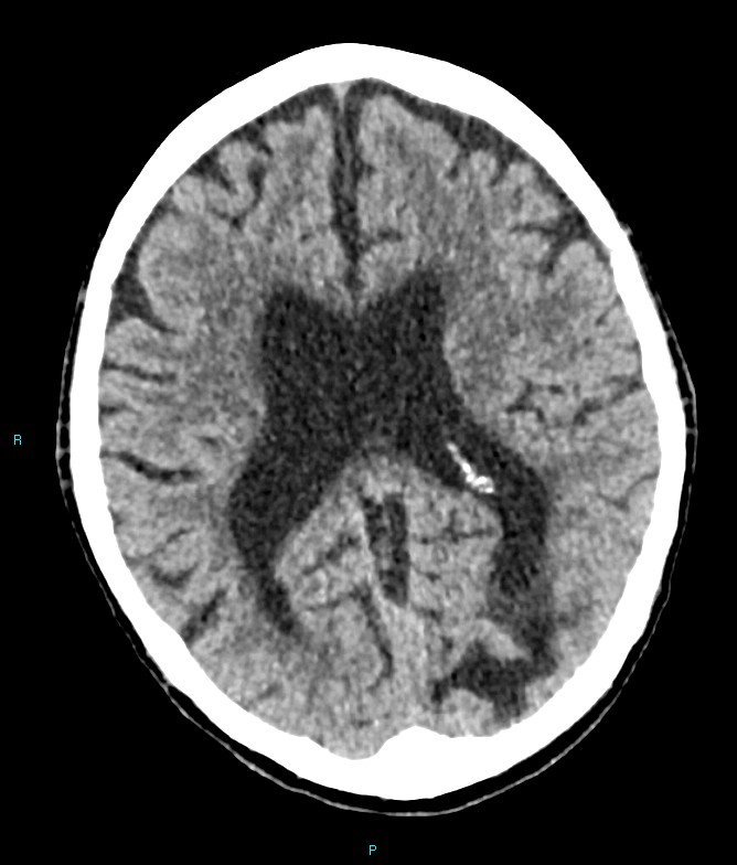 Calcified cerebral emboli from left ventricular thrombus (Radiopaedia 84420-99758 Axial non-contrast 42).jpg