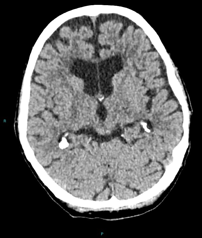 Calcified cerebral emboli from left ventricular thrombus (Radiopaedia 84420-99758 Axial non-contrast 54).jpg