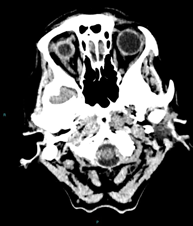 Calcified cerebral emboli from left ventricular thrombus (Radiopaedia 84420-99758 Axial non-contrast 82).jpg