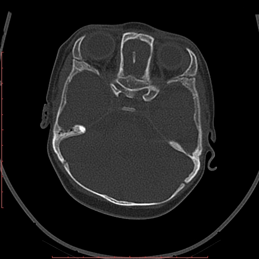 Calcified middle cerebral artery embolism (Radiopaedia 78949-91860 Axial bone window 11).jpg