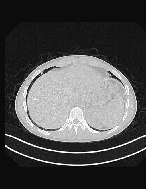 Calcifying pulmonary metastases (Radiopaedia 33359-34396 Axial lung window 56).jpg