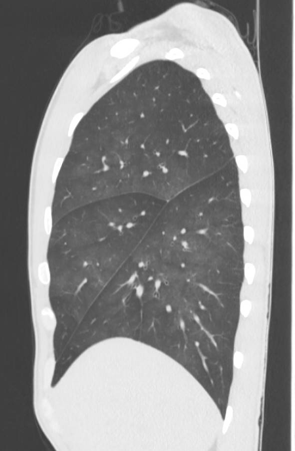 Cannabis-induced diffuse alveolar hemorrhage (Radiopaedia 89834-106946 Sagittal lung window 32).jpg