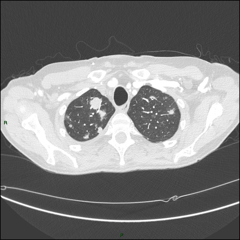 Cannonball metastases (Radiopaedia 82110-96150 Axial lung window 41).jpg