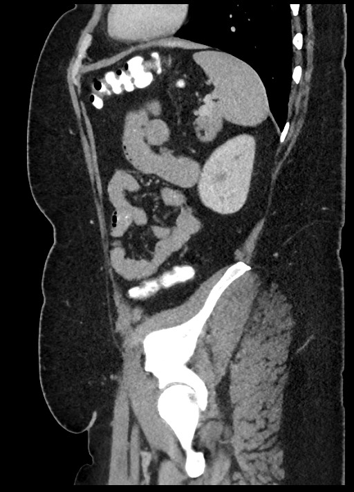 Carcinoid tumor - terminal ileum (Radiopaedia 60931-68739 C 17).jpg