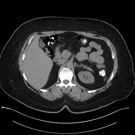 File:Carcinoid tumor - terminal ileum (Radiopaedia 60931-68740 Axial non-contrast 32).jpg