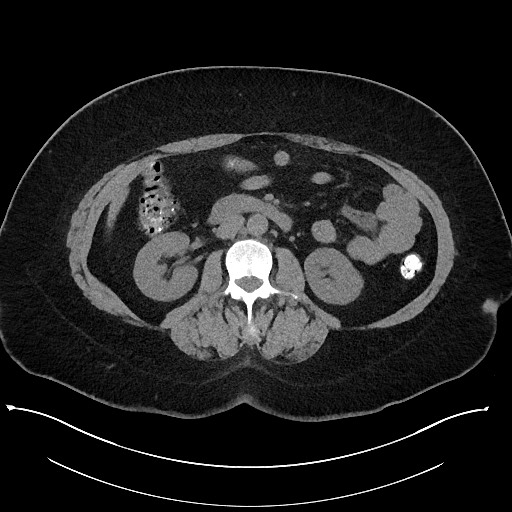Carcinoid tumor - terminal ileum (Radiopaedia 60931-68740 Axial non-contrast 52).jpg