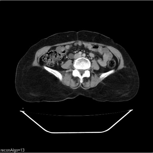File:Carcinoma cervix- recurrence (Radiopaedia 34702-36137 B 33).jpg