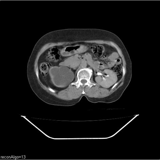File:Carcinoma cervix- recurrence (Radiopaedia 34702-36137 B 71).jpg