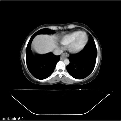 File:Carcinoma of esophagus (Radiopaedia 27356-27550 A 11).jpg