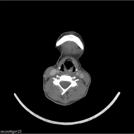 Carcinoma of the maxillary antrum (Radiopaedia 53805-59888 Axial C+ delayed 22).jpg