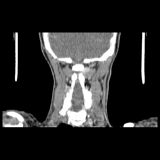 Carcinoma of the maxillary antrum (Radiopaedia 53805-59888 Coronal C+ delayed 130).jpg