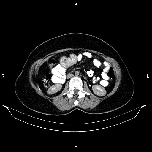 File:Carcinoma of uterine cervix (Radiopaedia 85861-101700 Axial C+ delayed 33).jpg