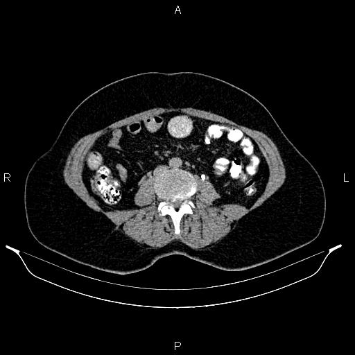 File:Carcinoma of uterine cervix (Radiopaedia 85861-101700 Axial C+ delayed 45).jpg