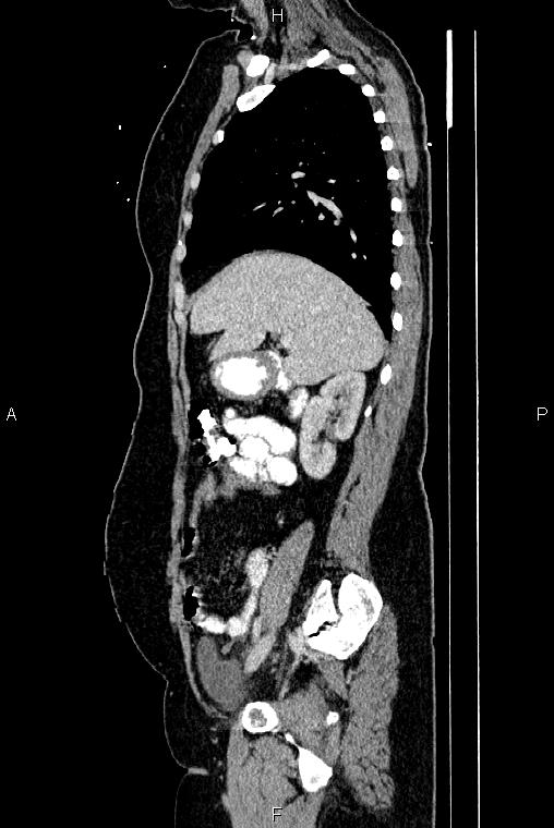 Carcinoma of uterine cervix (Radiopaedia 85861-101700 D 24).jpg