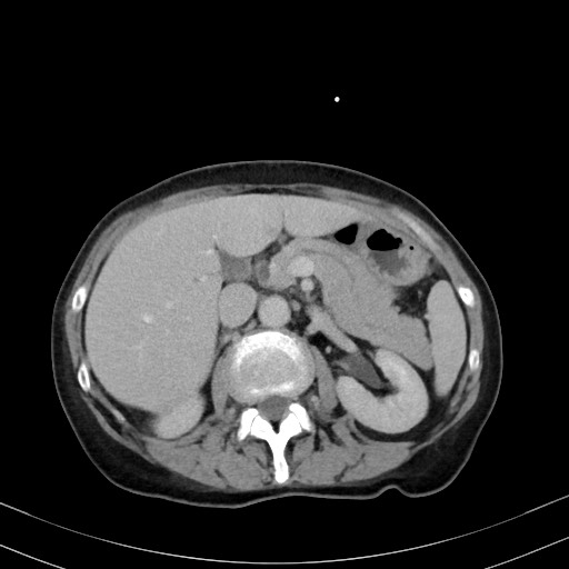 Carcinosarcoma (Radiopaedia 70401-80503 A 22).jpg