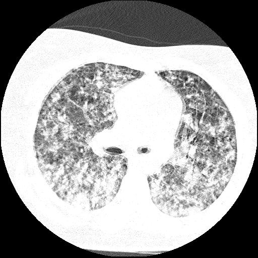 Cardiac angiosarcoma (Radiopaedia 66010-75181 Axial lung window 55).jpg