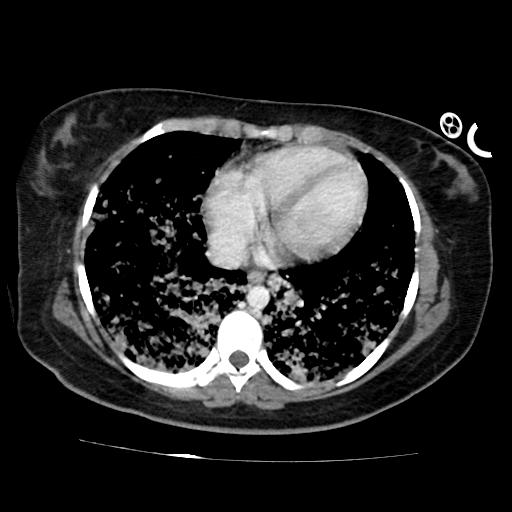 File:Cardiac angiosarcoma (Radiopaedia 66010-75181 B 95).jpg