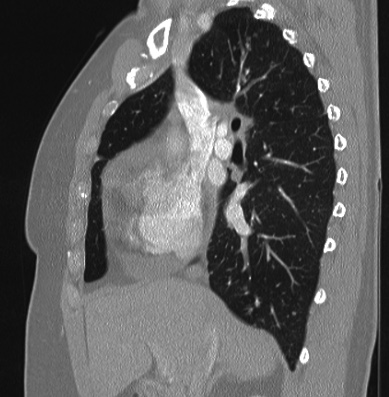 Cardiac sarcoidosis (Radiopaedia 74548-85534 Sagittal lung window 57).jpg