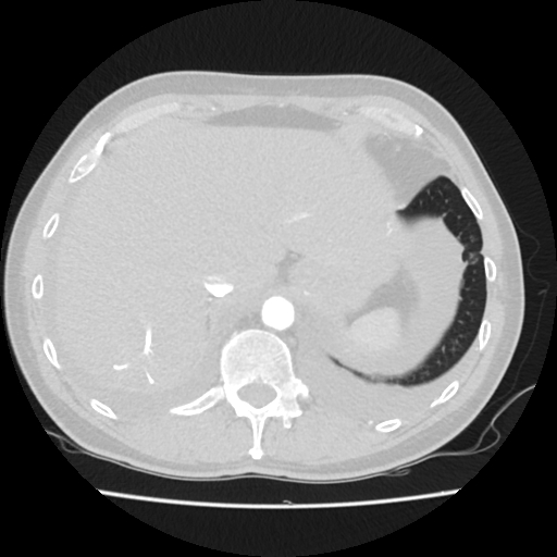 Cardiac tamponade (Radiopaedia 78607-91368 Axial lung window 85).jpg