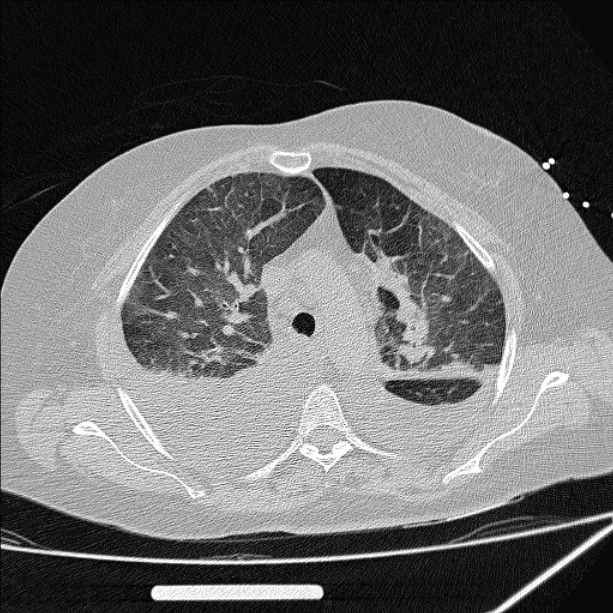 Cardiogenic pulmonary edema (Radiopaedia 29213-29609 Axial lung window 28).jpg