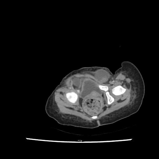 Caroli disease with autosomal recessive polycystic kidney disease (ARPKD) (Radiopaedia 89651-106703 B 216).jpg