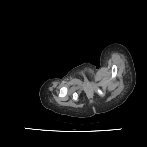 Caroli disease with autosomal recessive polycystic kidney disease (ARPKD) (Radiopaedia 89651-106703 B 242).jpg
