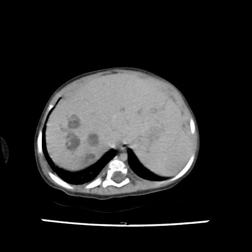 Caroli disease with autosomal recessive polycystic kidney disease (ARPKD) (Radiopaedia 89651-106703 B 29).jpg