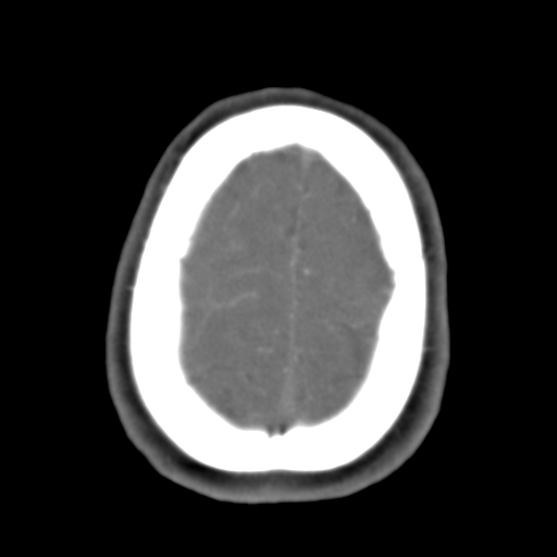 File:Carotico ophthalmic aneurysm (Radiopaedia 42916-46148 A 9).png