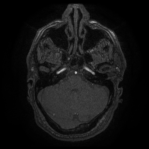 Carotid arterial dissection with acute cerebral infarction (Radiopaedia 26636-26784 MRA 136).jpg