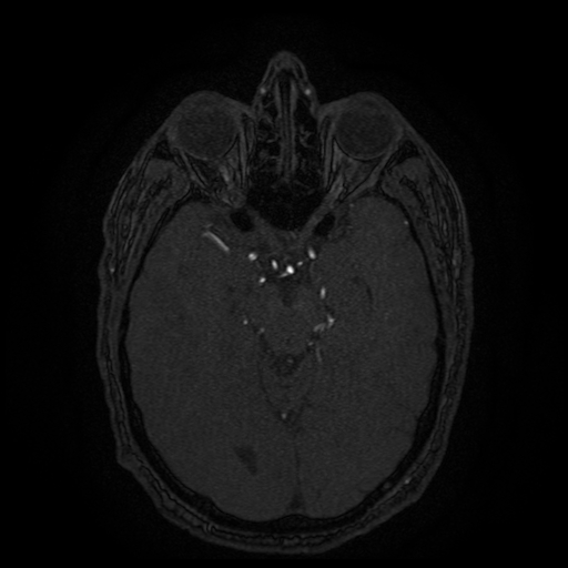 File:Carotid arterial dissection with acute cerebral infarction (Radiopaedia 26636-26784 MRA 99).jpg