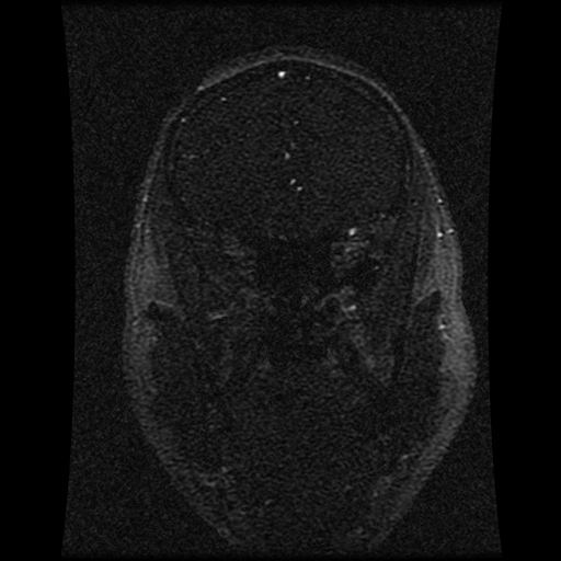 Carotid arterial dissection with acute cerebral infarction (Radiopaedia 26636-26784 MRV 122).jpg