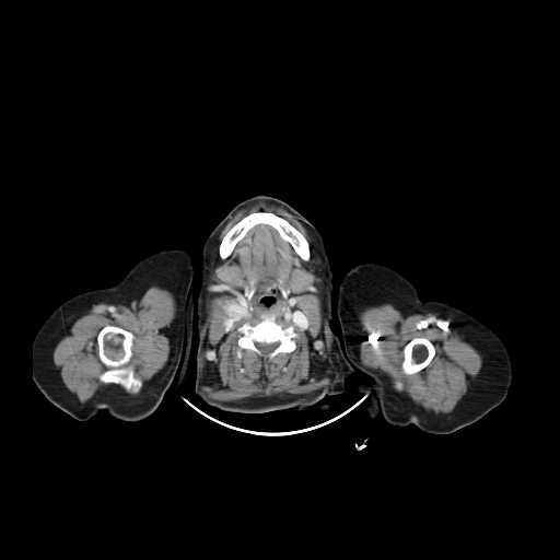 File:Carotid body tumor (Radiopaedia 21021-20948 B 15).jpg