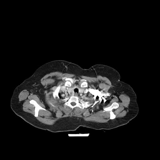 File:Carotid body tumor (Radiopaedia 21021-20948 B 24).jpg