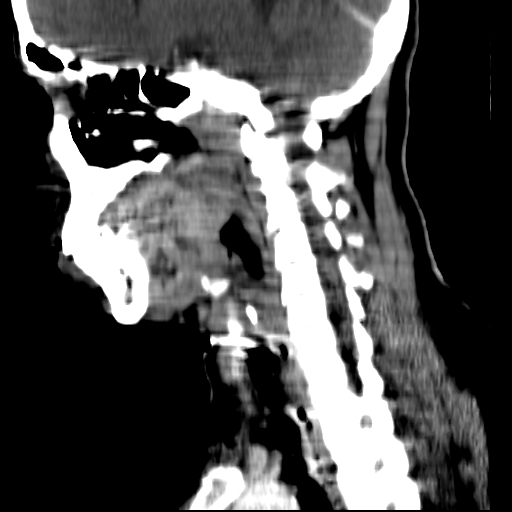 File:Carotid body tumor (Radiopaedia 27890-28124 C 9).jpg