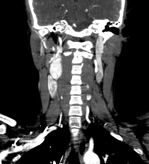 File:Carotid body tumor (Radiopaedia 39845-42300 C 50).jpg