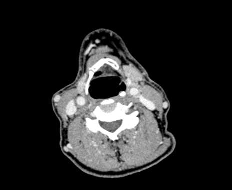 Carotid body tumor (Radiopaedia 61750-69757 Axial Post contrast 60).jpg