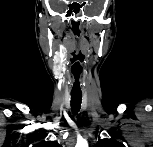 File:Carotid body tumor (Radiopaedia 83615-98727 B 52).jpg