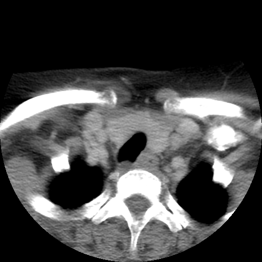 File:Carotid body tumor (paraganglioma) (Radiopaedia 38586-40729 A 29).jpg