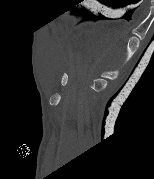 File:Carpal fractures (smart watch impaction) (Radiopaedia 55844-62430 Coronal bone window 21).jpg