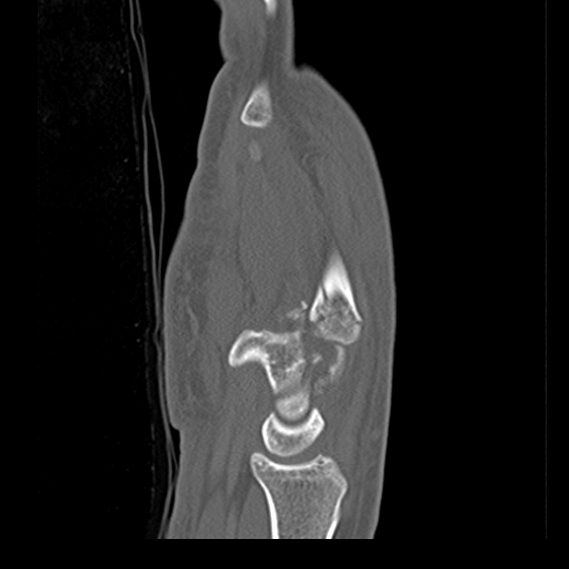 File:Carpo-metacarpal fracture-dislocations with hamatum split fracture (Radiopaedia 18482-18343 Sagittal bone window 11).jpg