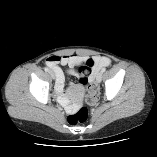 Castleman disease with fibrous pseudotumor in the abdomen (Radiopaedia 77296-89373 A 109).jpg