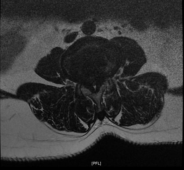 File:Cauda equina syndrome from lumbar disc bulge (Radiopaedia 6754-7954 Axial T2 1).jpg