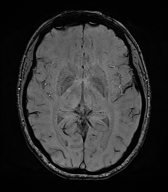File:Cavernoma with bleed - midbrain (Radiopaedia 54546-60773 Axial SWI 24).png