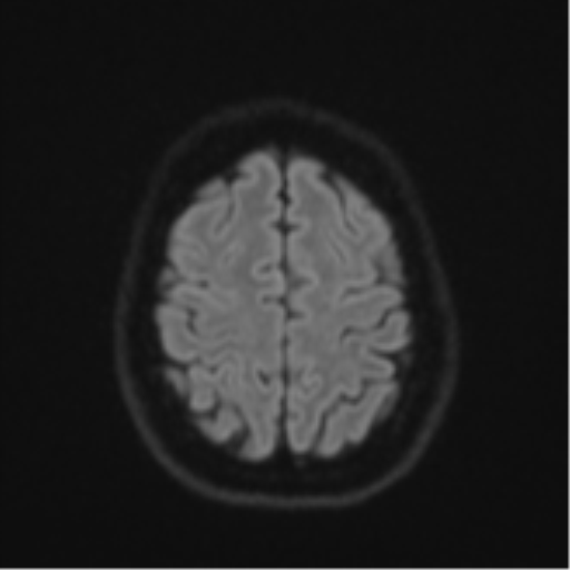 File:Cavernoma with bleed - midbrain (Radiopaedia 54546-60774 Axial DWI 50).png