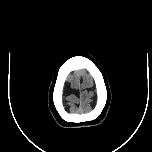 Cavernous hemangioma of the cerebellar falx (Radiopaedia 73025-83723 Axial non-contrast 128).jpg