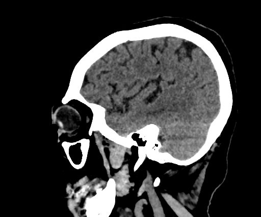 Cavernous hemangioma of the cerebellar falx (Radiopaedia 73025-83723 B 82).jpg