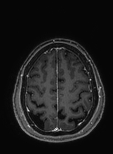 Cavernous hemangioma of the cerebellar falx (Radiopaedia 73025-83724 Axial T1 C+ 75).jpg