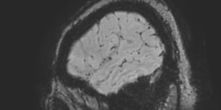 File:Cavernous hemangioma of the cerebellar falx (Radiopaedia 73025-83724 Sagittal BOLD 21).jpg