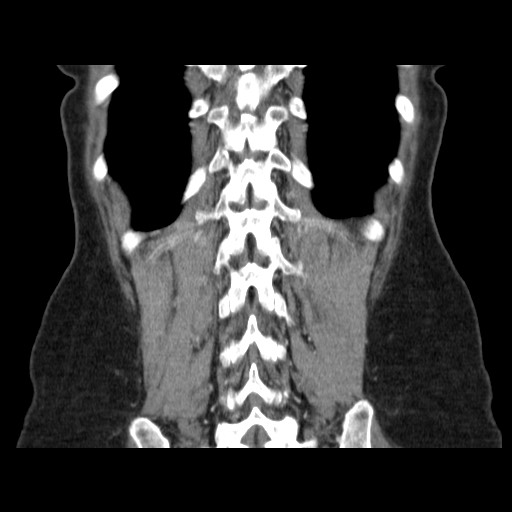 Cavernous hepatic hemangioma (Radiopaedia 75441-86667 C 123).jpg